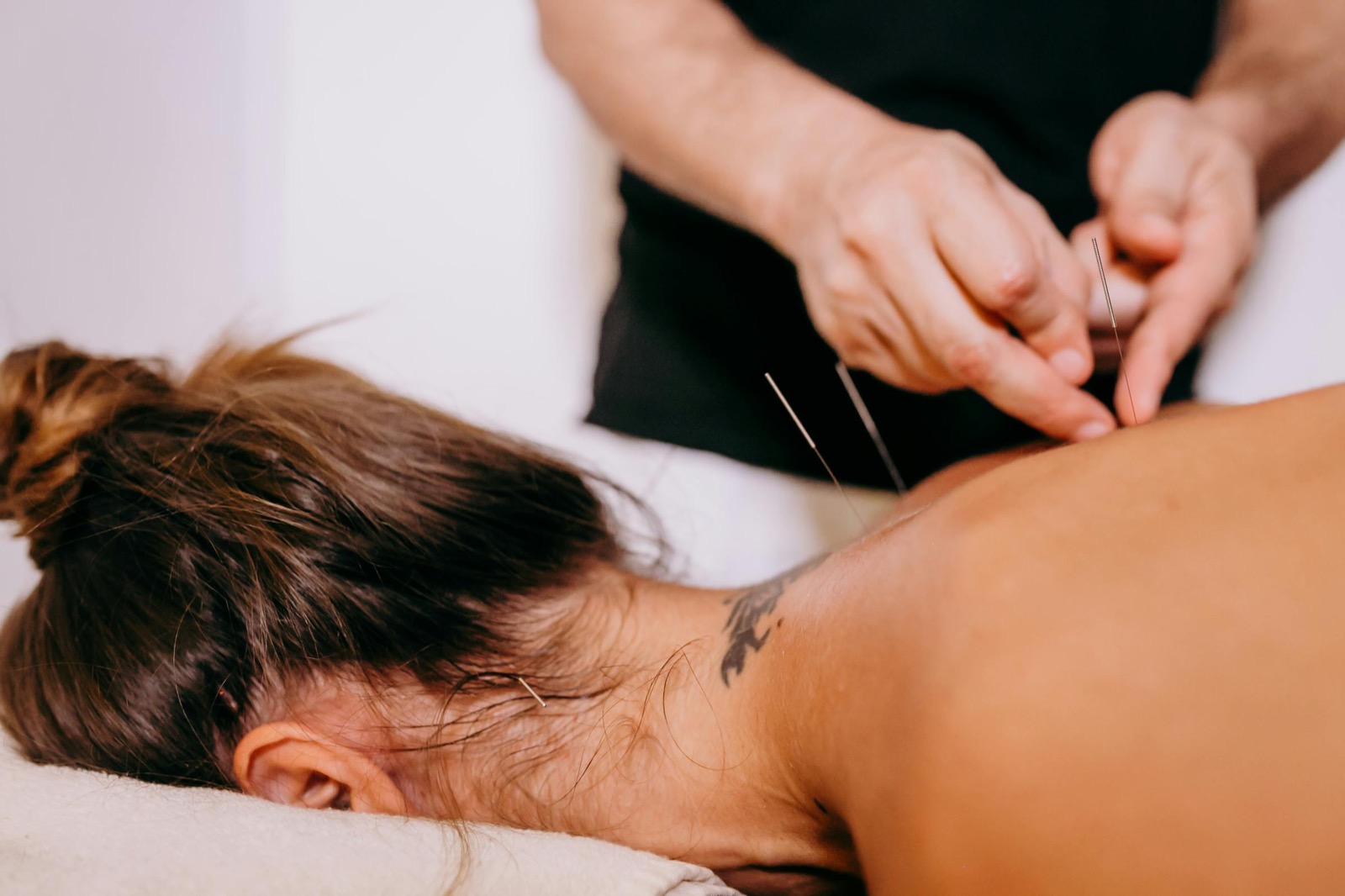 Professional acupuncture back treatment with needles at Kingsfoil Acupuncture Goshen NY